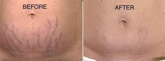 CO2 Laser for Stretch Marks Before and After
